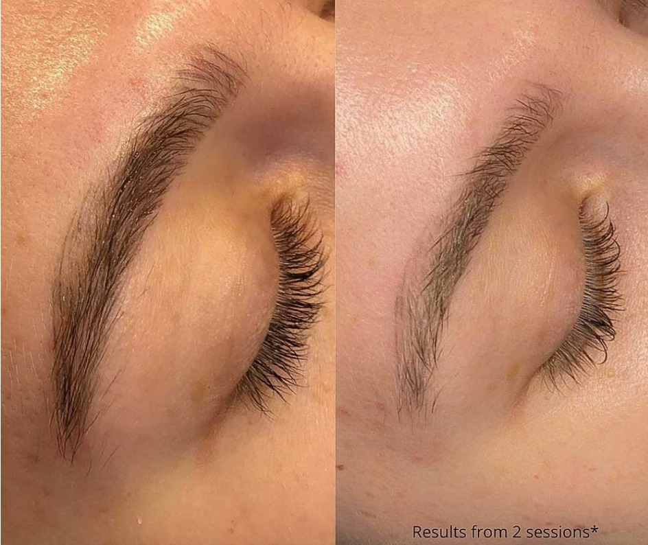removal for microblading