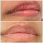 Lip Neutralization in Atlanta, GA