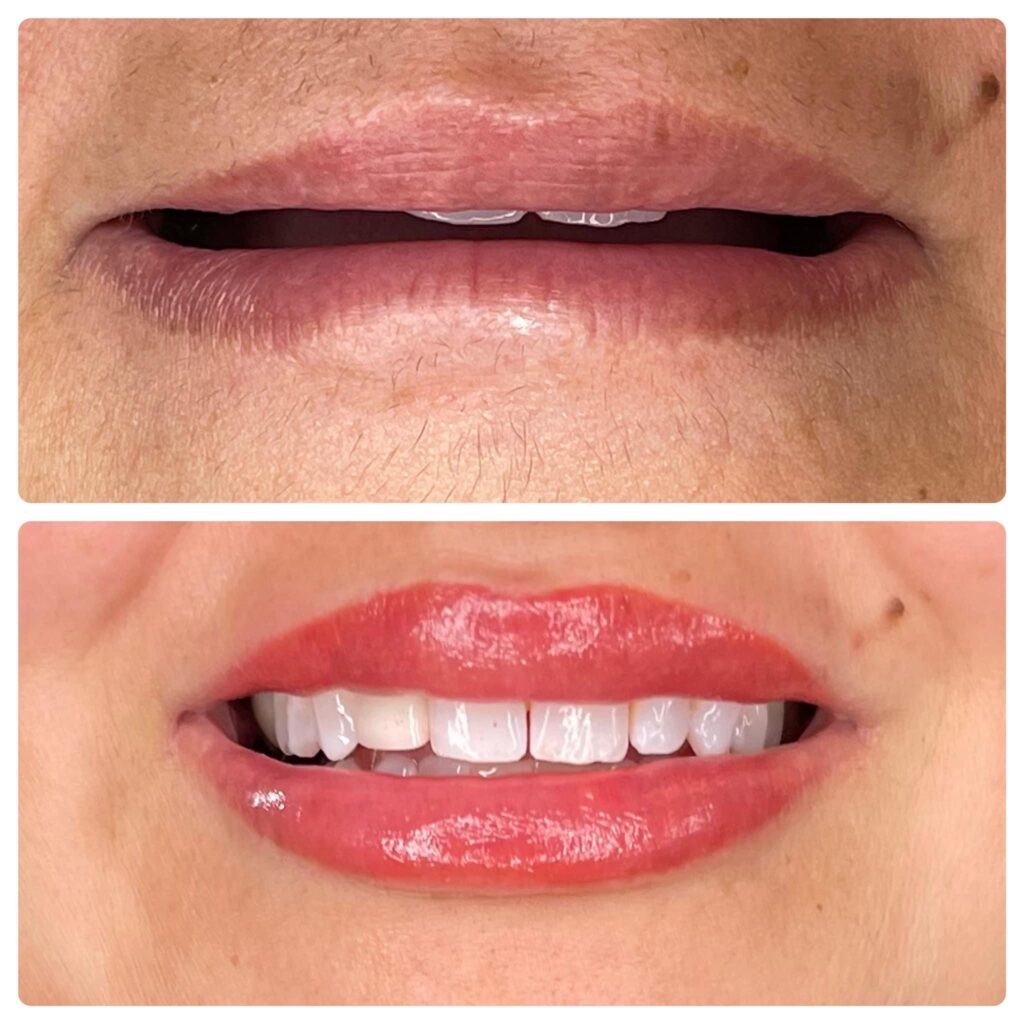corrective lip scar with lip blush